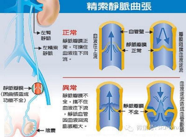 關于2021年征兵精索靜脈曲張標準的探討，2021年征兵精索靜脈曲張標準深度解析